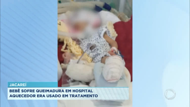 Vídeo: Bebê é internado com queimaduras no corpo