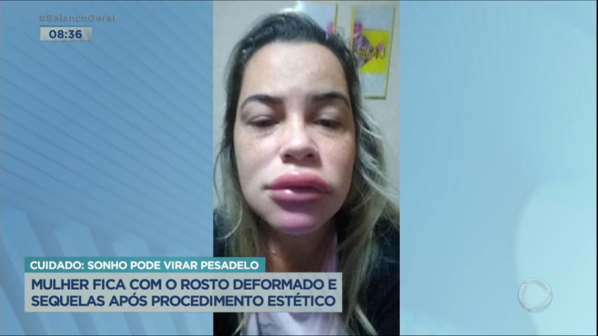Vídeo: Mulher fica com rosto deformado após se submeter a procedimento estético