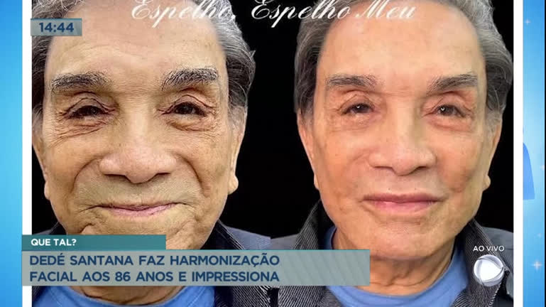 Vídeo: Dedé Santana impressiona ao fazer harmonização facial aos 86 anos