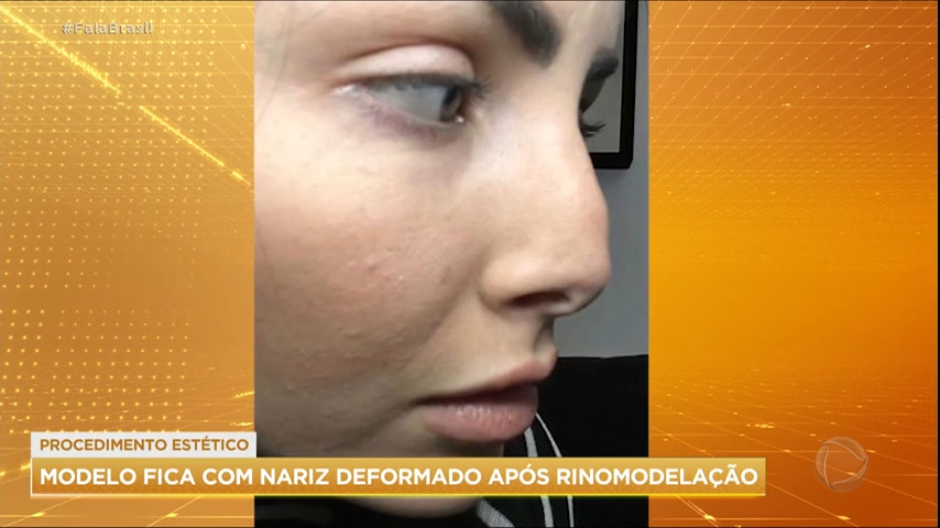 Modelo faz rinomodelação definitiva e fica com o nariz deformado - RecordTV  - R7 Fala Brasil