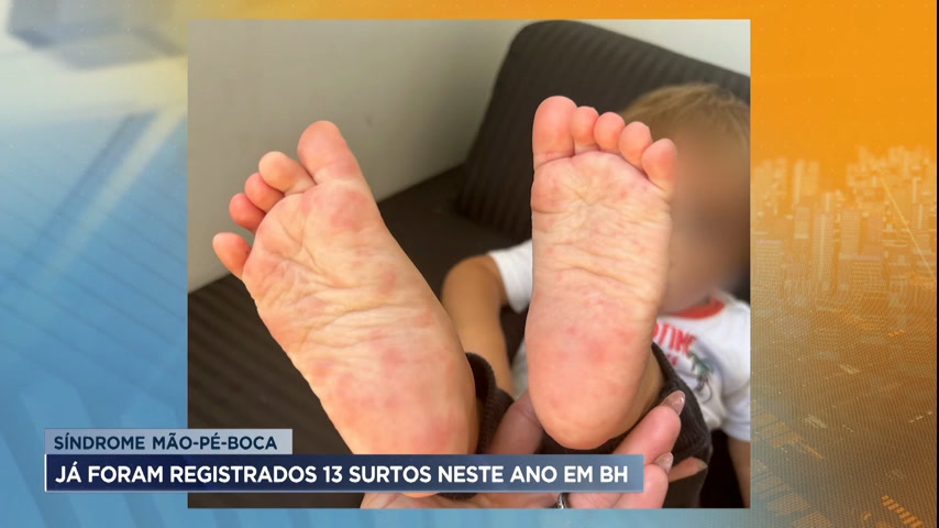 Vídeo: Síndrome mão-pé-boca tem surto em BH e preocupa pais