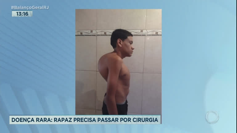 Vídeo: Jovem que tem doença rara precisa de cirurgia na coluna com urgência no Rio