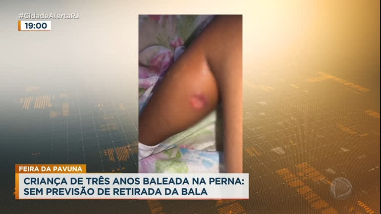 Vídeo: Criança é internada com bala alojada na perna na zona norte do Rio