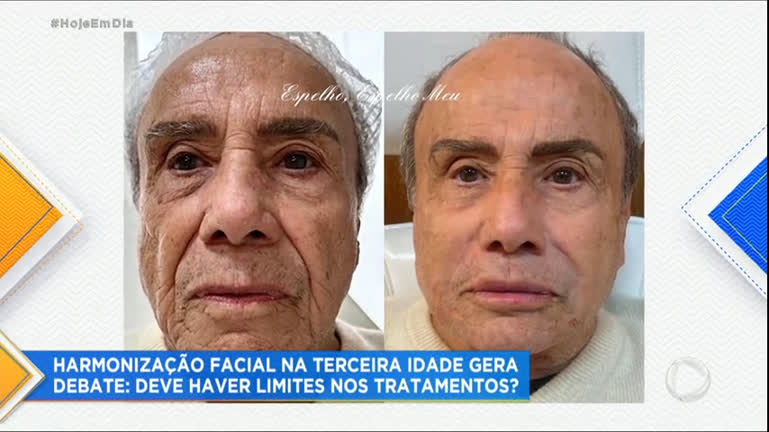Vídeo: Harmonização facial de idosos levanta debate sobre procedimentos estéticos