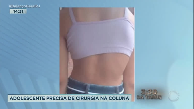 Cirurgia que mudou vida de menina que tinha 'coluna em S' completa