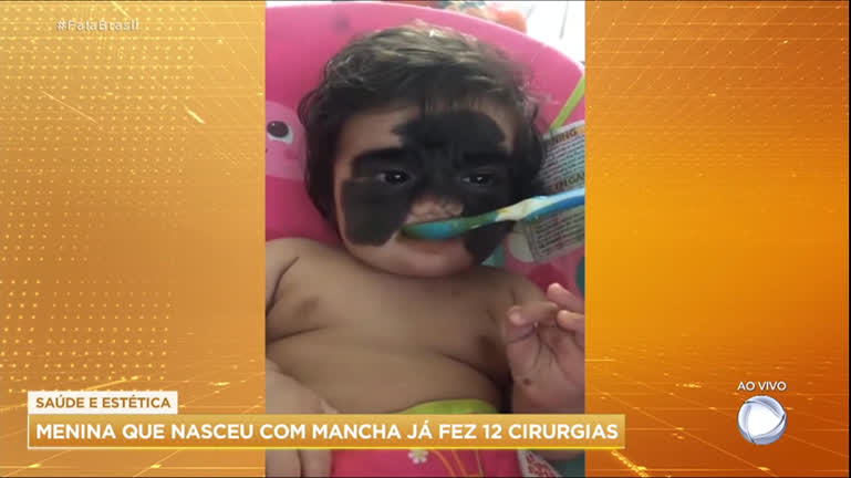 Vídeo: Menina que nasceu com mancha no rosto já passou por 12 cirurgias