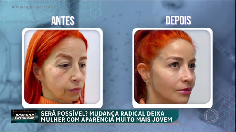  Venezuelana de 56 anos "volta no tempo" após harmonização facial