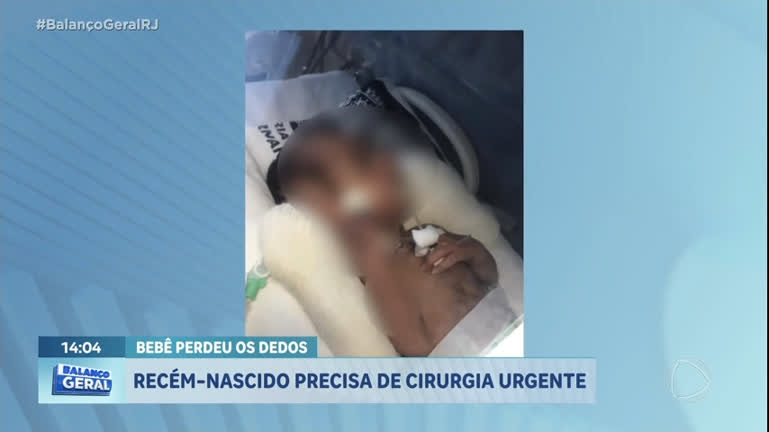 Vídeo: Bebê terá que amputar dedos das mãos por causa de infecção hospitalar no Rio