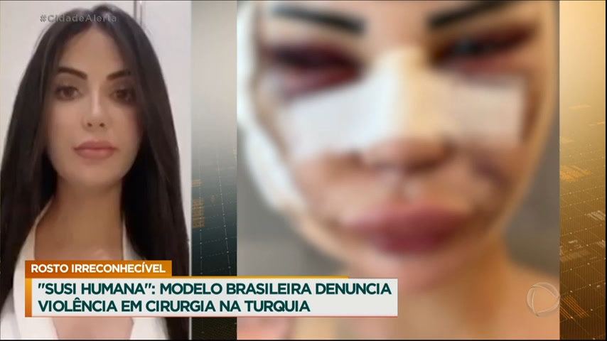 Vídeo: Modelo brasileira denuncia violência em cirurgia na Turquia