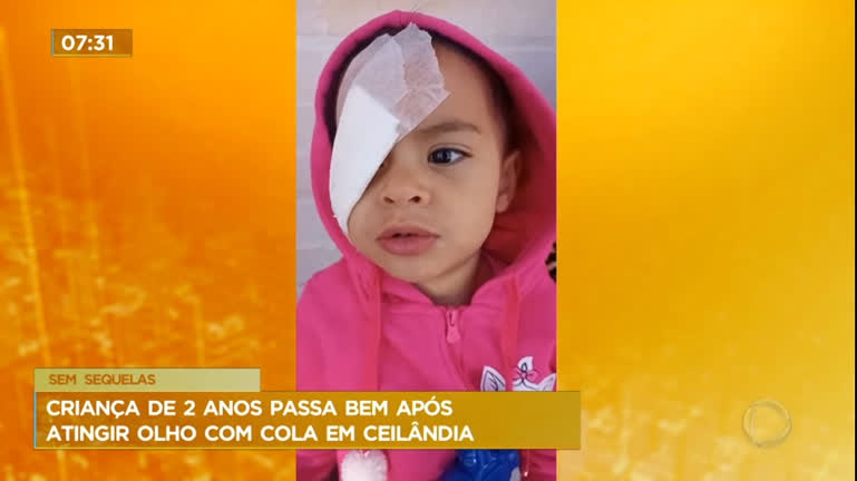 Vídeo: Menina de 2 anos passa por procedimento após grudar olho com cola instantânea no DF
