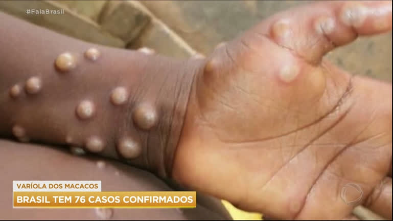 Vídeo: Ministério da Saúde confirma 76 casos de varíola dos macacos no Brasil