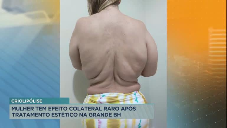 Vídeo: Mulher tem efeito colateral raro após tratamento estético na Grande BH