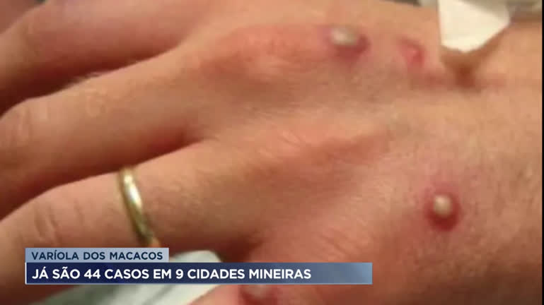Vídeo: Quarenta e quatro casos de varíola dos macacos são confirmados em Minas Gerais
