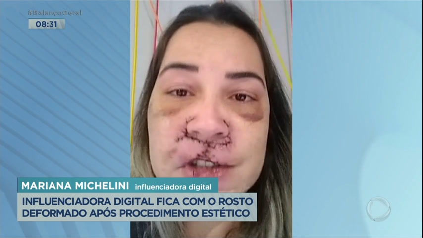 Vídeo: Influenciadora fica com rosto deformado e sequelas após procedimento estético