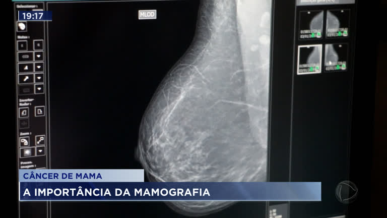 Vídeo: Cai a procura por mamografia durante a pandemia