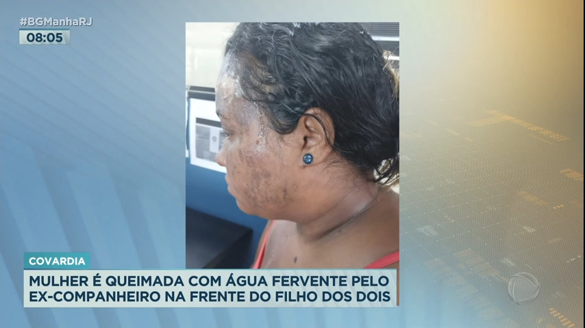Vídeo: Mulher é queimada com água fervente pelo ex-companheiro em São Gonçalo (RJ)