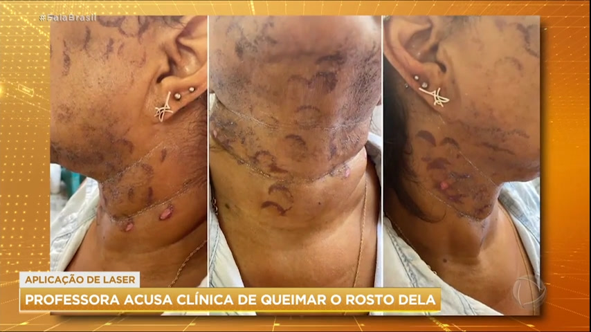 Vídeo: Professora diz que ficou com rosto queimado após procedimento estético