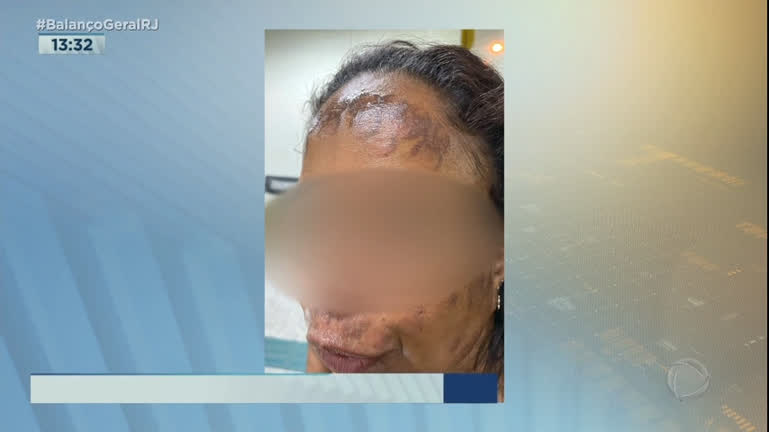 Vídeo: Mulher fica com rosto queimado após sessão de depilação a laser em Mesquita