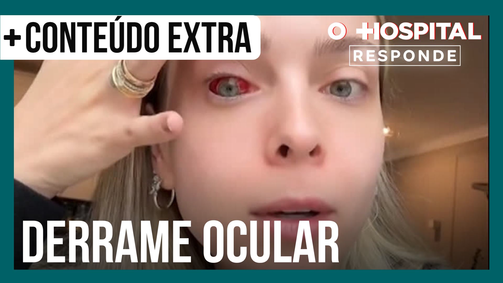 Vídeo: Tata Estaniecki sofre derrame ocular; oftalmologista explica condição | O Hospital Responde