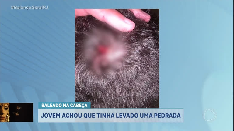 Vídeo: Jovem descobre projétil alojado na cabeça quatro dias após ter sido baleado em Cabo Frio (RJ)