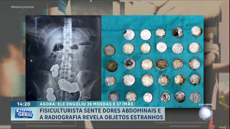 Vídeo: Fisiculturista é operado após engolir 39 moedas e 37 ímãs