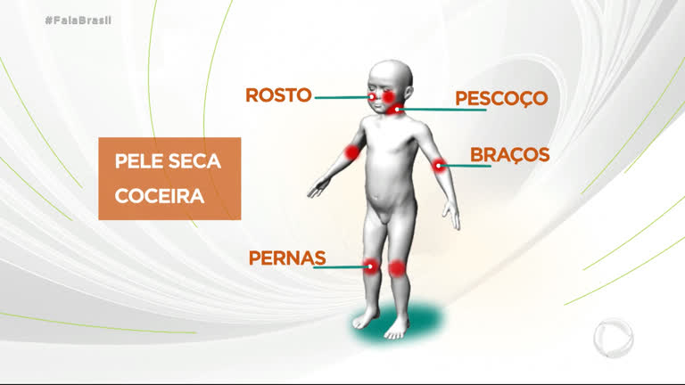 Vídeo: Dermatite atópica afeta até 25% das crianças brasileiras