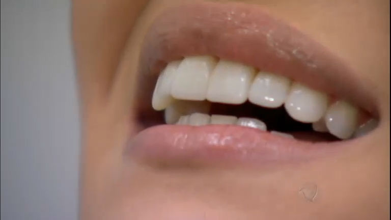 Vídeo: "Lentes de contato" para os dentes prometem sorriso perfeitos em poucas horas