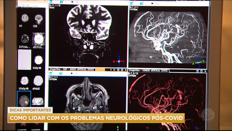 Vídeo: Saiba como lidar com os problemas neurológicos pós-covid