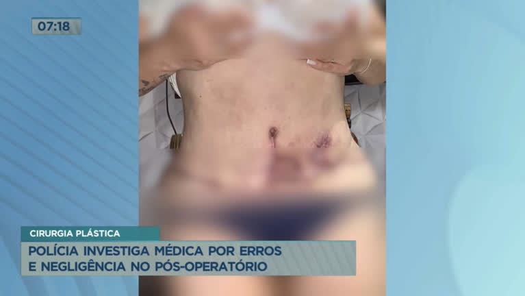 Vídeo: Polícia investiga médica por erros e negligência em cirurgias plásticas