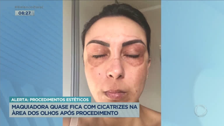 Vídeo: Maquiadora sofre com inflamações após fazer procedimento estético